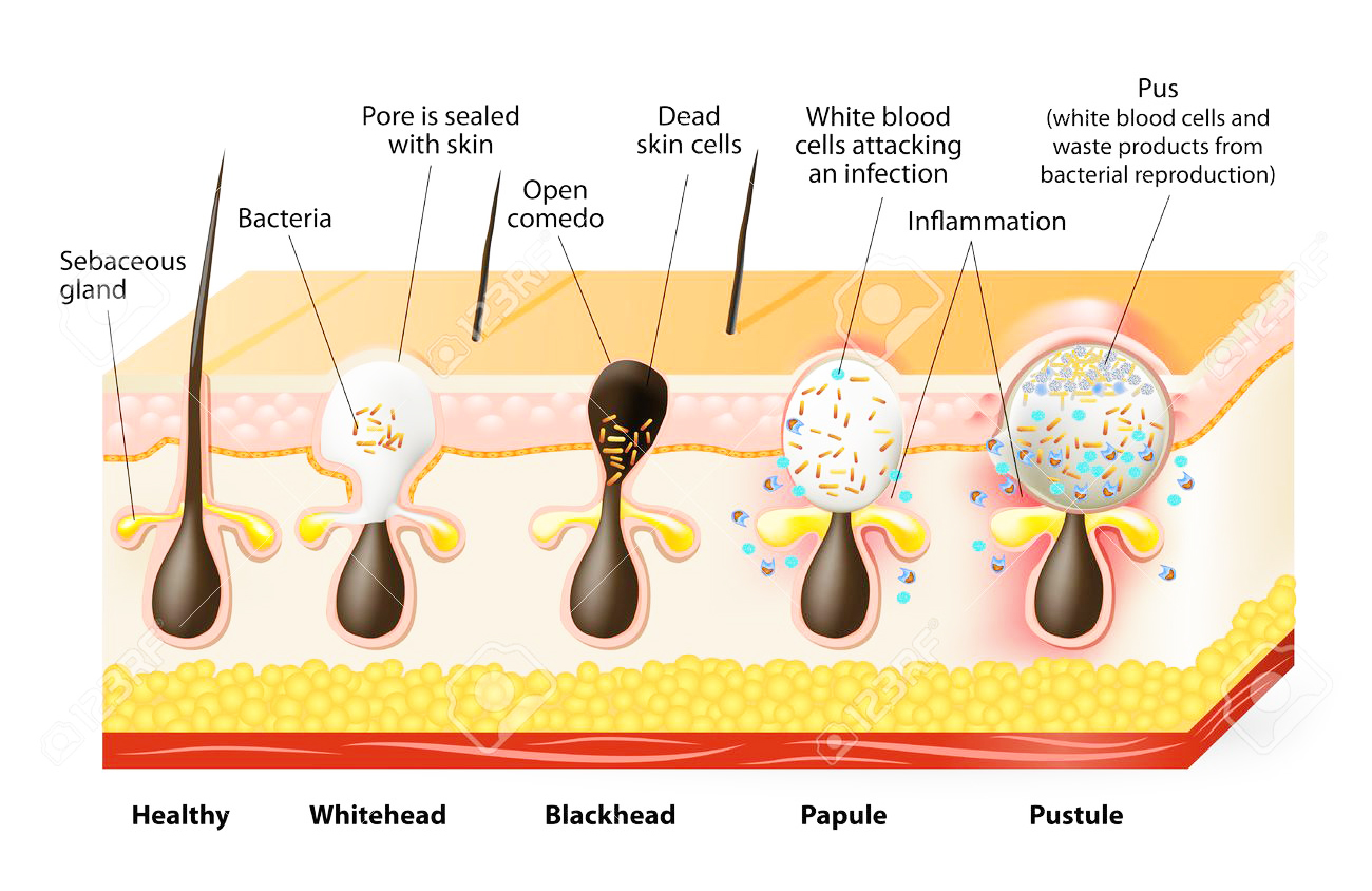 What’s the difference between whiteheads and blackheads?