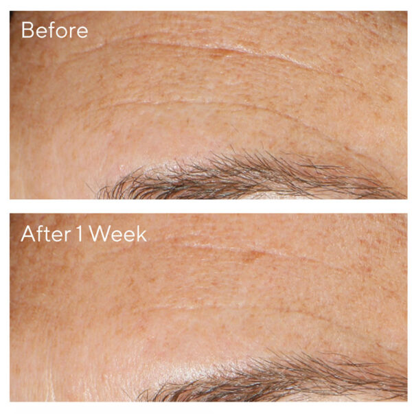Murad Replenishing Multi - Acid Peel 100ml